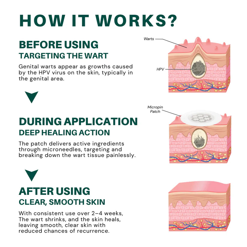 Fivfivgo® Magnesium MicroPin HPV Genital Wart Removal Patch