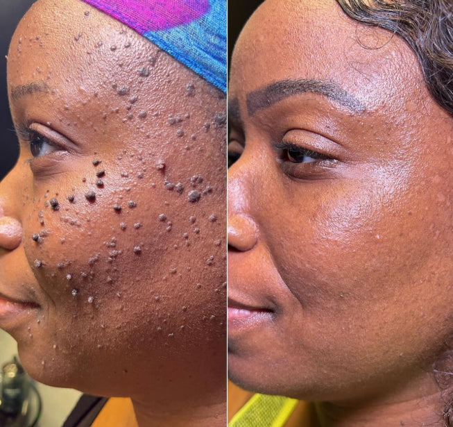 SERYNTHTM ACNE TREATMENTADAPALENE GEL