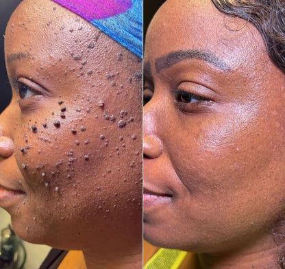 SERYNTHTM ACNE TREATMENTADAPALENE GEL