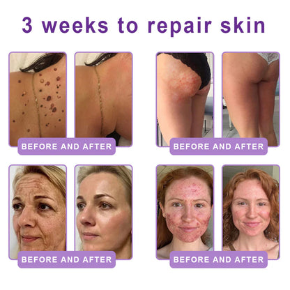 FDA Official: HISKIN PDRN Multi-Peptide Massaging Body RollerCream- Anti-aging, Hydrating, Skin Firming & Lifting, Skin Repair, Even Tone, Acne and Dark Spot Treatment, Wart and Mole Removal, and Psoriasis Relief.