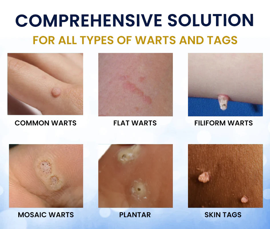 ❄️ Fast-Acting Cryo Formula! ✨ Freeze Blemishes Instantly!  Skin Tag Cryo Treatment Spray