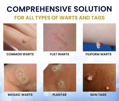 ❄️ Fast-Acting Cryo Formula! ✨ Freeze Blemishes Instantly!  Skin Tag Cryo Treatment Spray