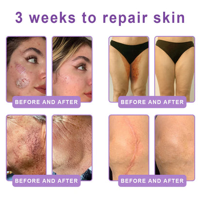 FDA Official: HISKIN PDRN Multi-Peptide Massaging Body RollerCream- Anti-aging, Hydrating, Skin Firming & Lifting, Skin Repair, Even Tone, Acne and Dark Spot Treatment, Wart and Mole Removal, and Psoriasis Relief.