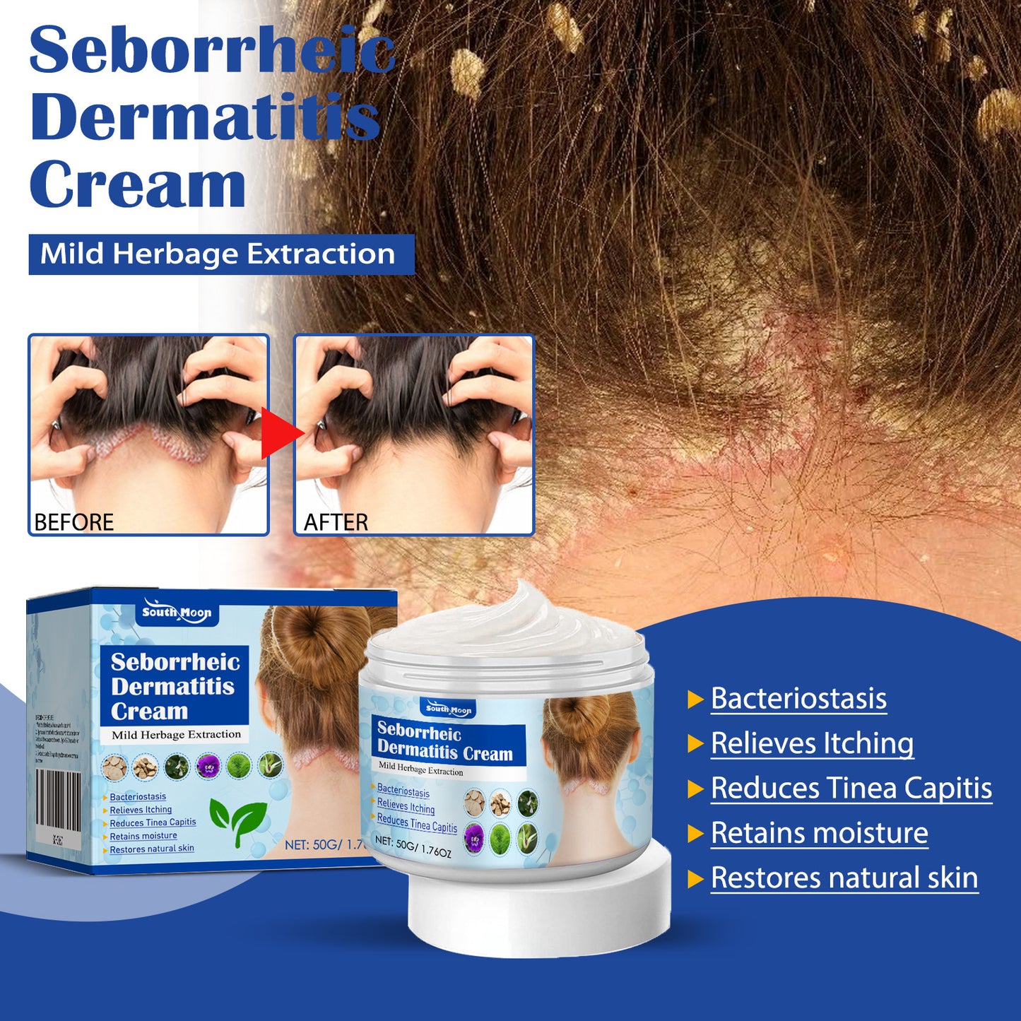 South moon -🔥Skin care cream for improving scalp and acne skin problems