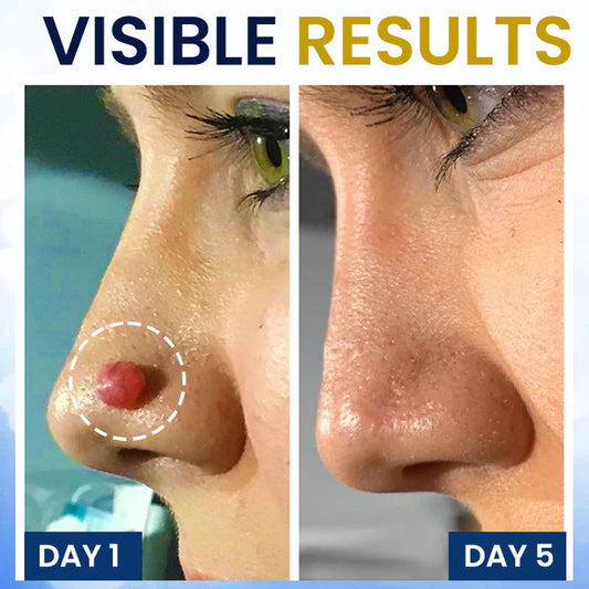 ❄️ Fast-Acting Cryo Formula! ✨ Freeze Blemishes Instantly!  Skin Tag Cryo Treatment Spray