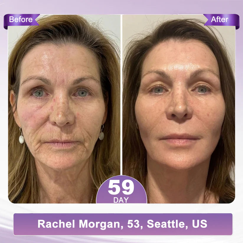 FDA Official: HISKIN PDRN Multi-Peptide Massaging Body RollerCream- Anti-aging, Hydrating, Skin Firming & Lifting, Skin Repair, Even Tone, Acne and Dark Spot Treatment, Wart and Mole Removal, and Psoriasis Relief.