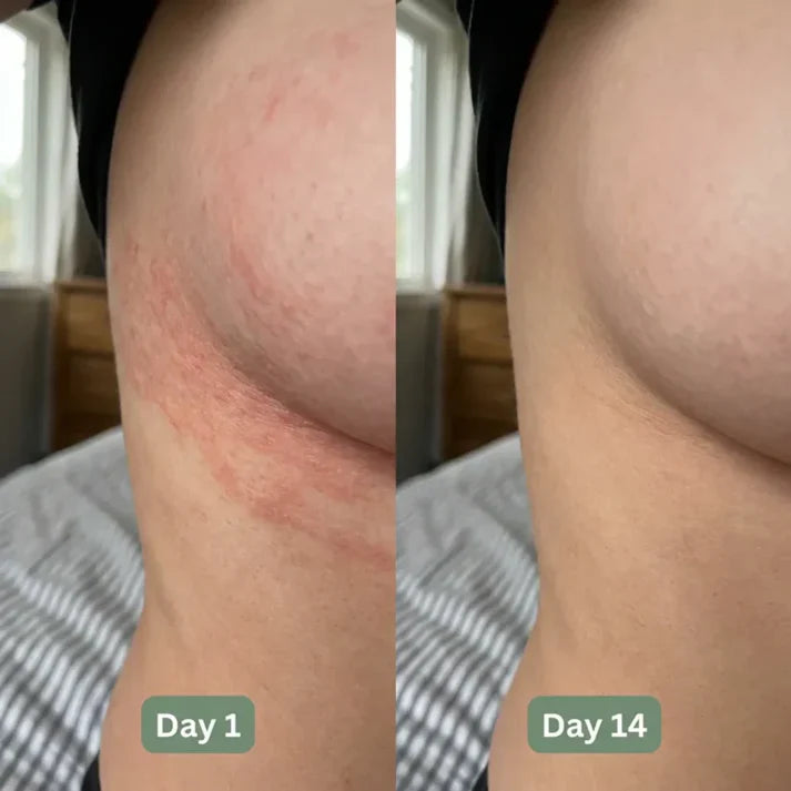 💚 LAST DAY BUY 1 GET 1 FREE✨Intertrigo Relief Cream treats 99% of skin fold rashes from the first application SevoreaTMIntertrigo Cream🛒