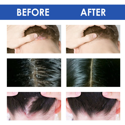 South moon -🔥Skin care cream for improving scalp and acne skin problems