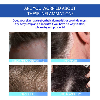 South moon -🔥Skin care cream for improving scalp and acne skin problems