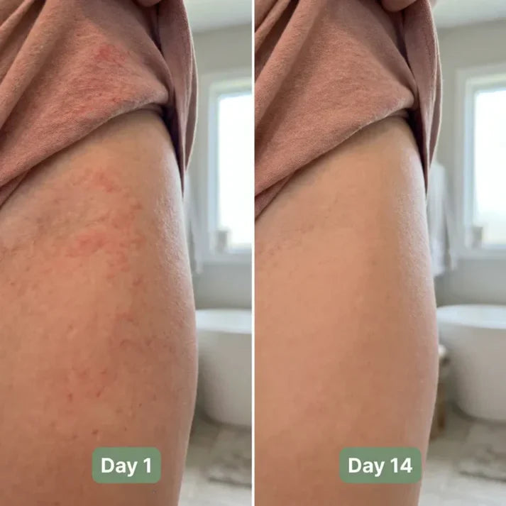 💚 LAST DAY BUY 1 GET 1 FREE✨Intertrigo Relief Cream treats 99% of skin fold rashes from the first application SevoreaTMIntertrigo Cream🛒