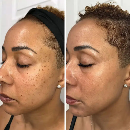 SERYNTHTM ACNE TREATMENTADAPALENE GEL